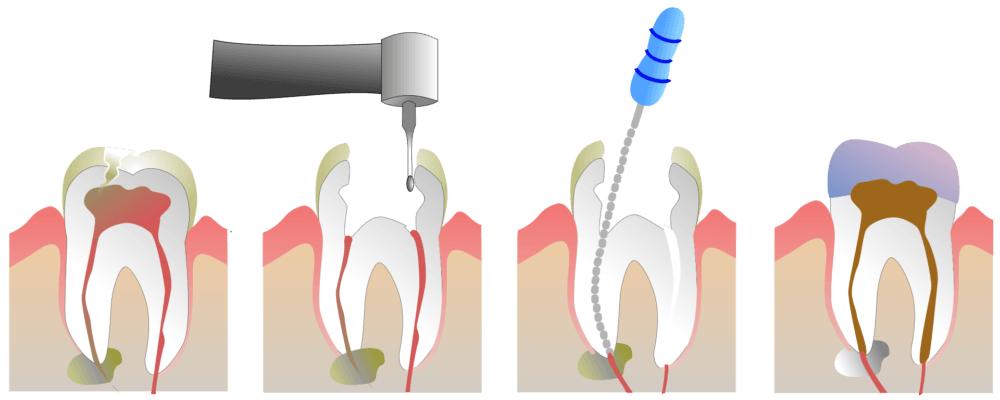 Root Canal in Fenton Michigan